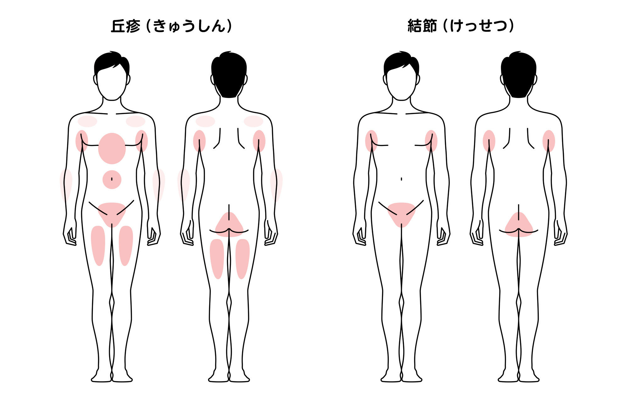 丘疹(きゅうしん)と結節(けっせつ)