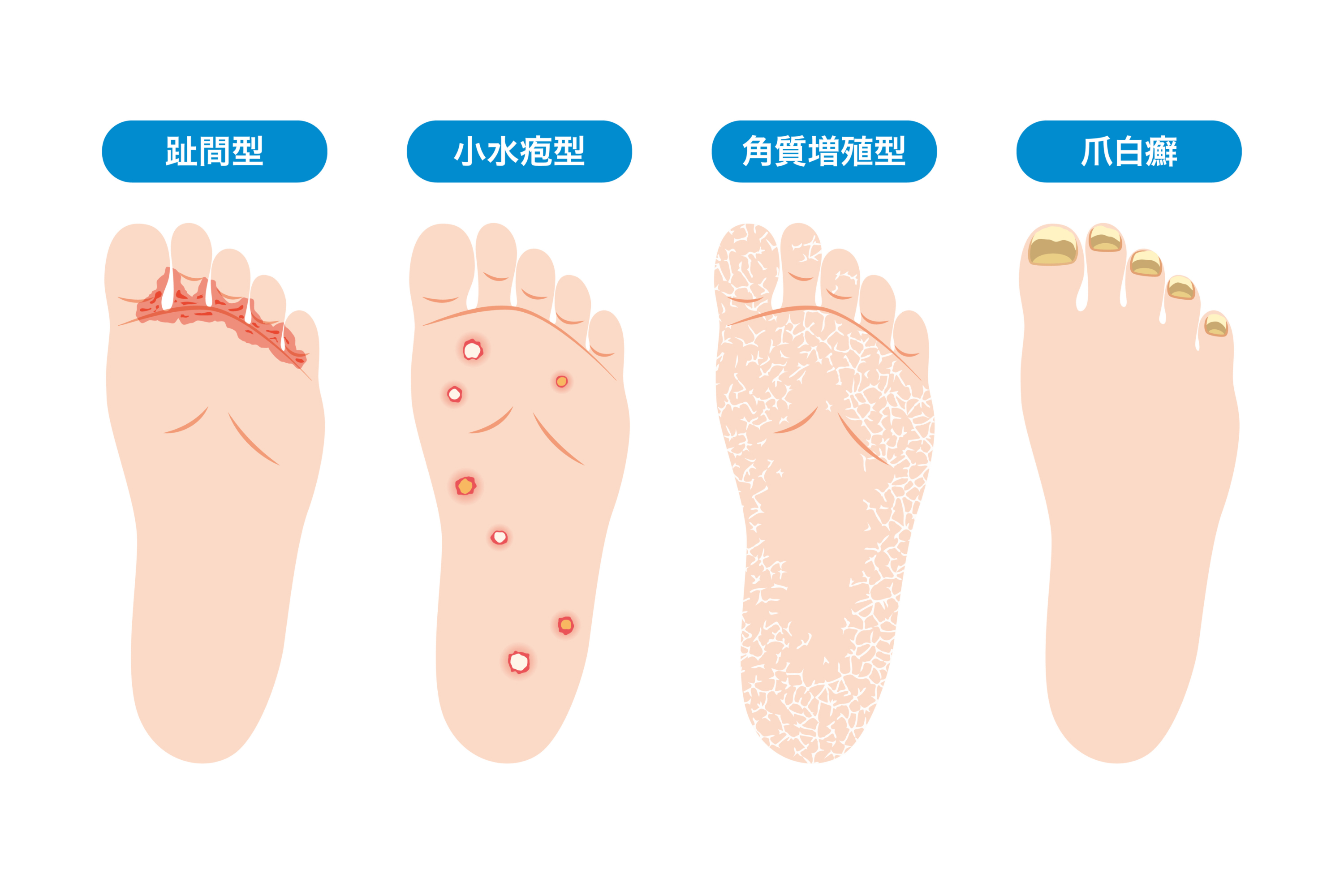 白癬（はくせん）の種類と主な症状
